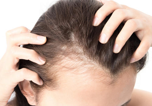 Ce este caderea parului sau alopecia? Afla cauzele ei – part 1